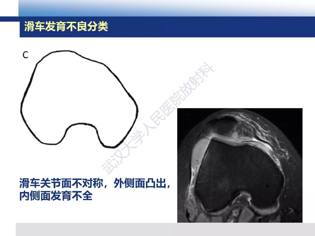 【PPT】髌骨不稳的影像学评价
