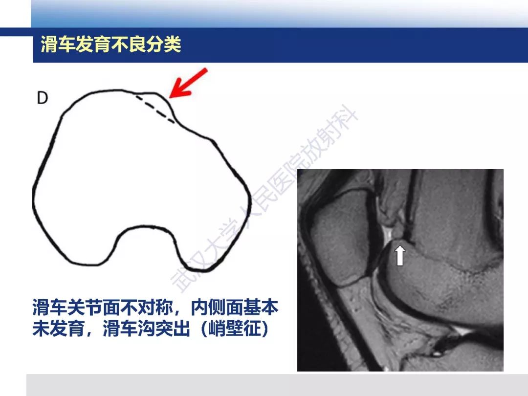 【PPT】髌骨不稳的影像学评价