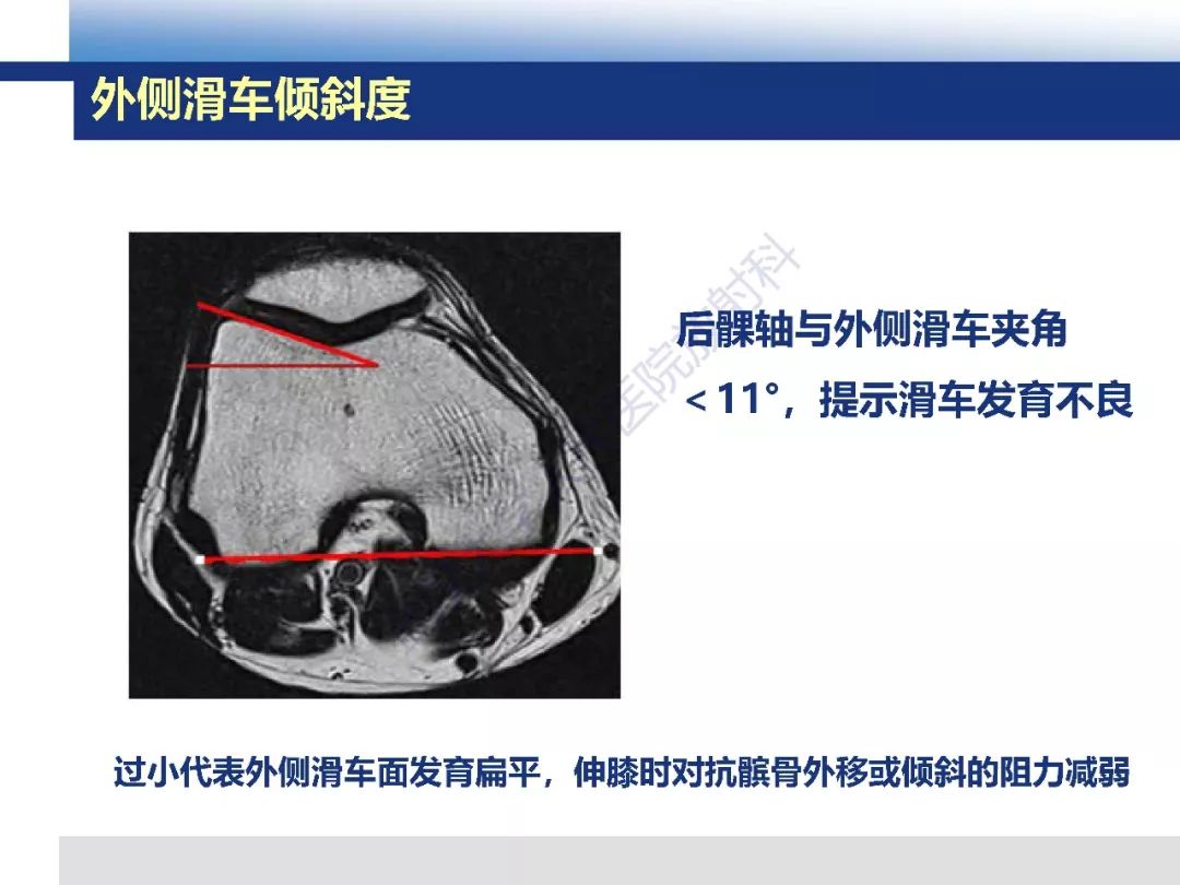 【PPT】髌骨不稳的影像学评价