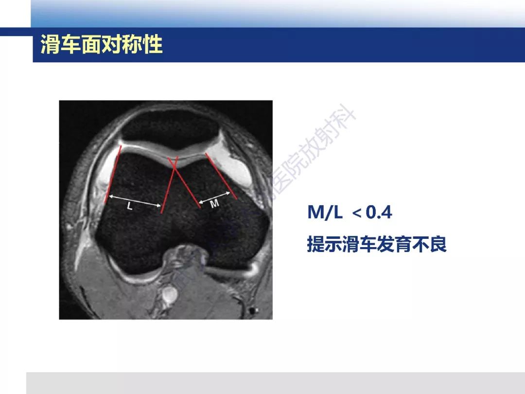 【PPT】髌骨不稳的影像学评价