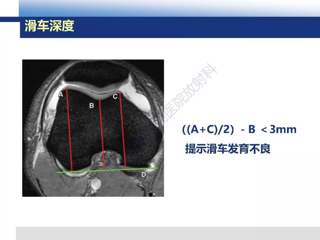 【PPT】髌骨不稳的影像学评价