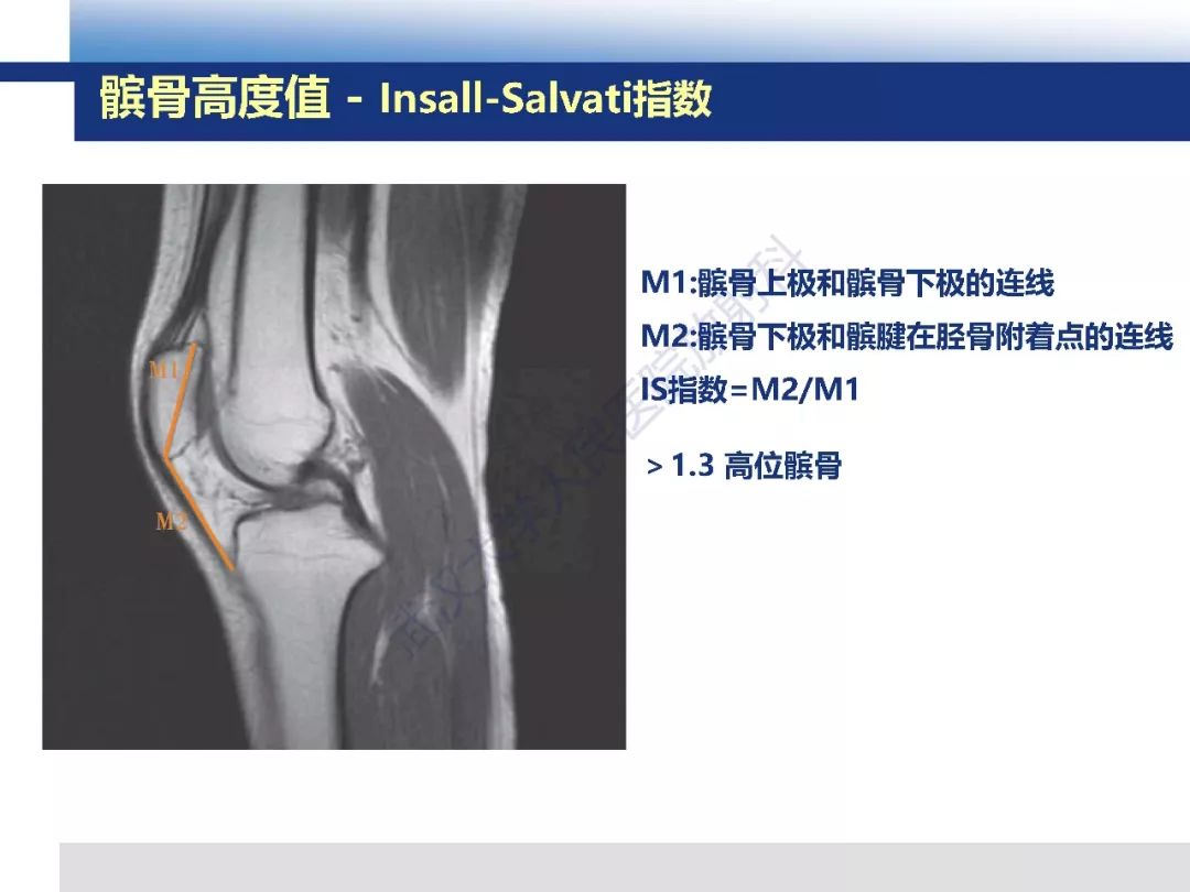 【PPT】髌骨不稳的影像学评价