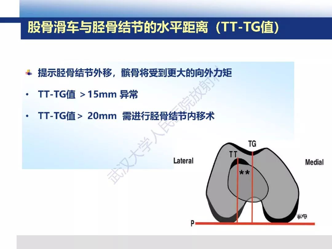 【PPT】髌骨不稳的影像学评价