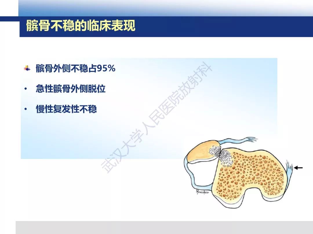 【PPT】髌骨不稳的影像学评价