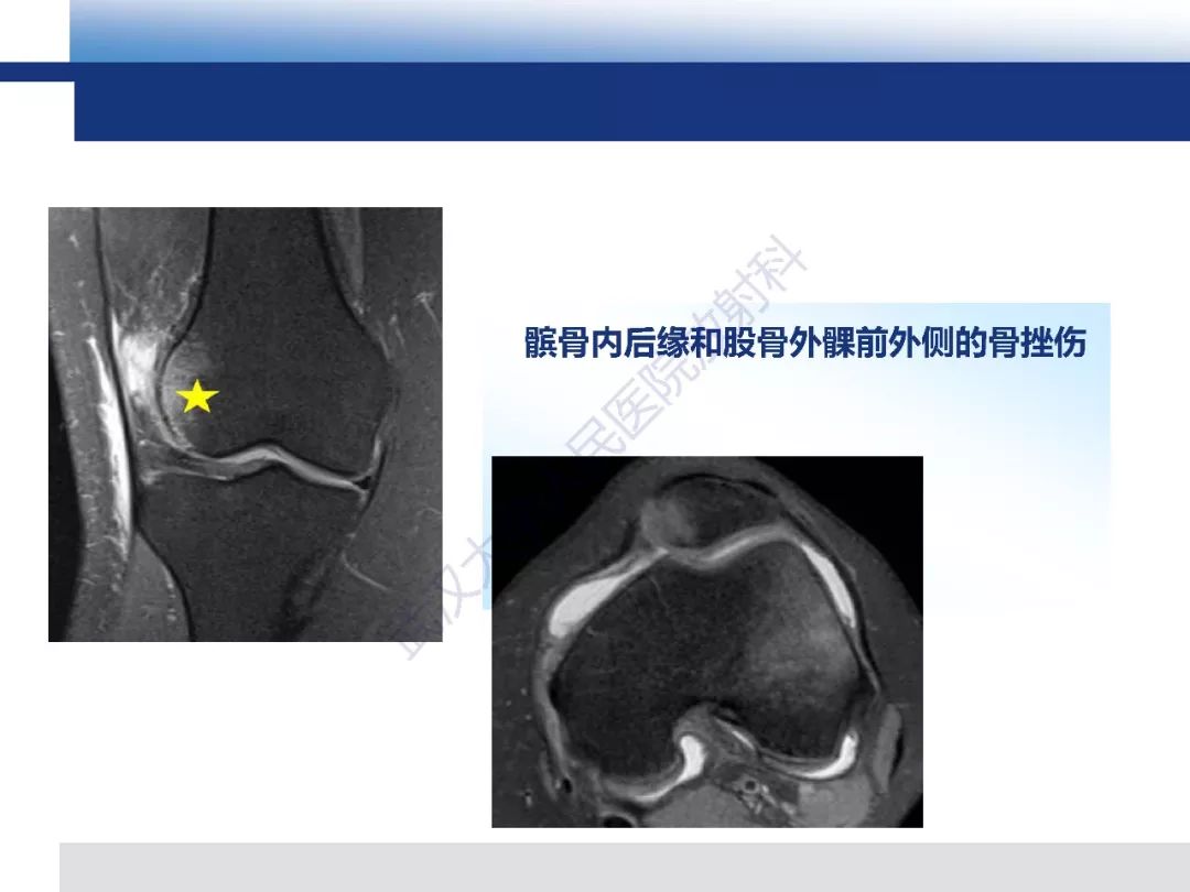 【PPT】髌骨不稳的影像学评价