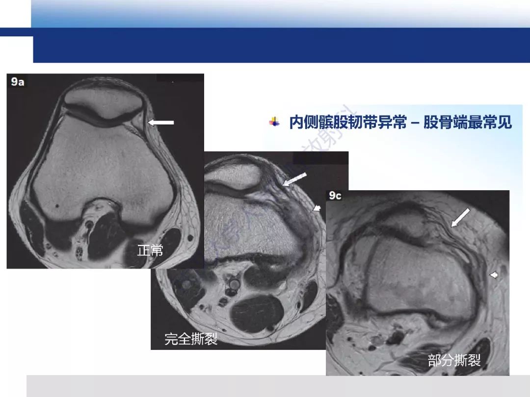 【PPT】髌骨不稳的影像学评价