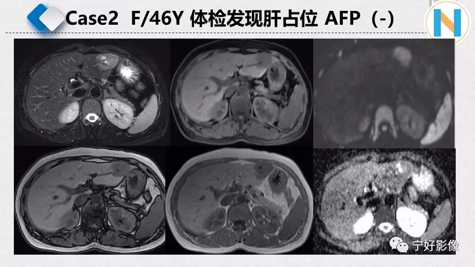 【PPT】肝脏血管平滑肌脂肪瘤影像表现及鉴别诊断 【PPT】肝脏血管平滑肌脂肪瘤影像表现及鉴别诊断