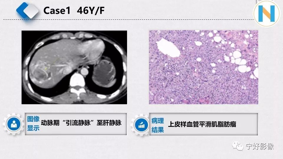 【PPT】肝脏血管平滑肌脂肪瘤影像表现及鉴别诊断 【PPT】肝脏血管平滑肌脂肪瘤影像表现及鉴别诊断