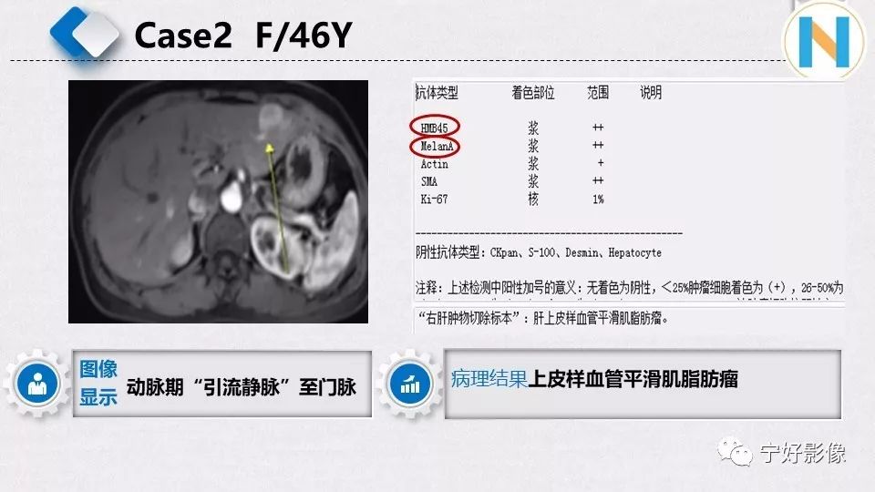 【PPT】肝脏血管平滑肌脂肪瘤影像表现及鉴别诊断 【PPT】肝脏血管平滑肌脂肪瘤影像表现及鉴别诊断