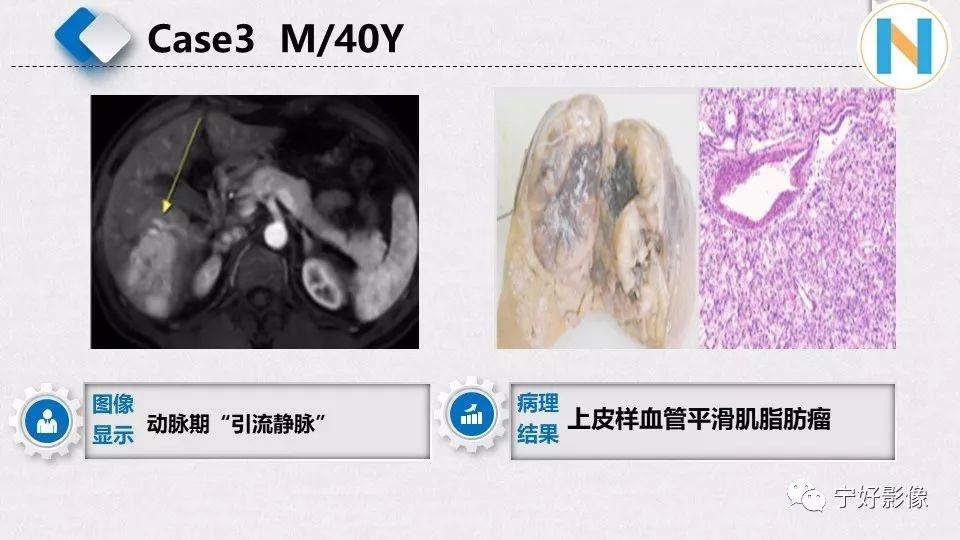 【PPT】肝脏血管平滑肌脂肪瘤影像表现及鉴别诊断 【PPT】肝脏血管平滑肌脂肪瘤影像表现及鉴别诊断