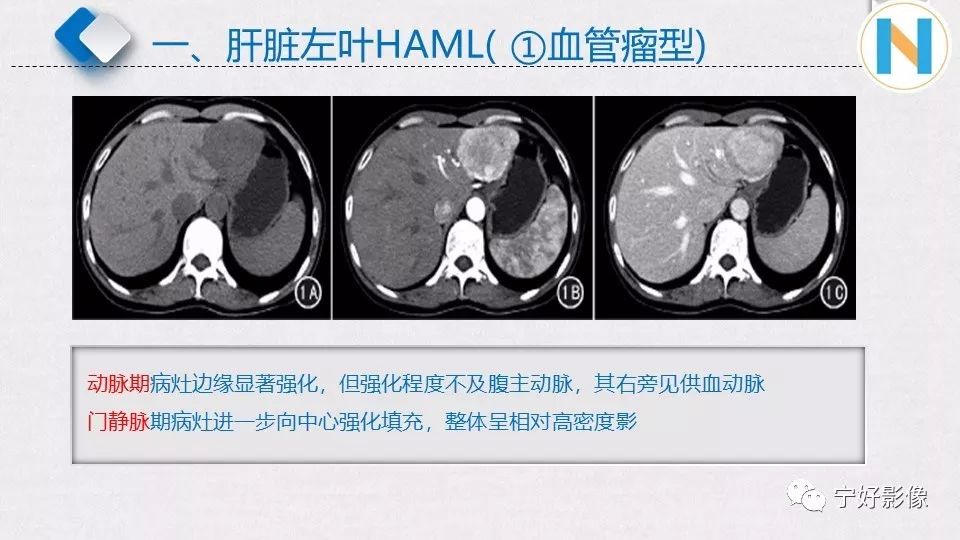 【PPT】肝脏血管平滑肌脂肪瘤影像表现及鉴别诊断 【PPT】肝脏血管平滑肌脂肪瘤影像表现及鉴别诊断