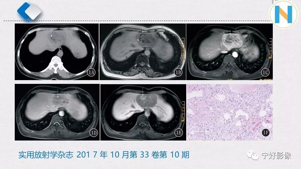 【PPT】肝脏血管平滑肌脂肪瘤影像表现及鉴别诊断 【PPT】肝脏血管平滑肌脂肪瘤影像表现及鉴别诊断