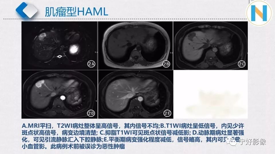 【PPT】肝脏血管平滑肌脂肪瘤影像表现及鉴别诊断 【PPT】肝脏血管平滑肌脂肪瘤影像表现及鉴别诊断