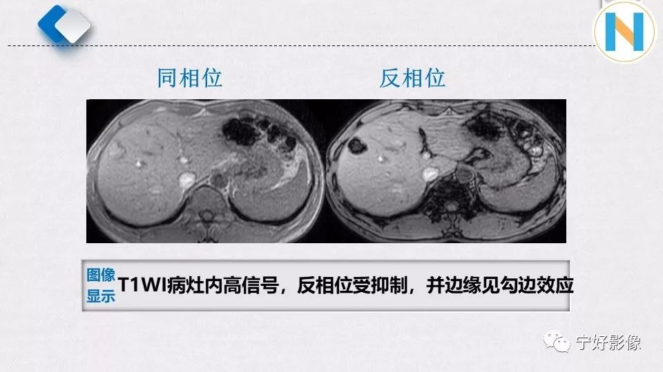 【PPT】肝脏血管平滑肌脂肪瘤影像表现及鉴别诊断 【PPT】肝脏血管平滑肌脂肪瘤影像表现及鉴别诊断