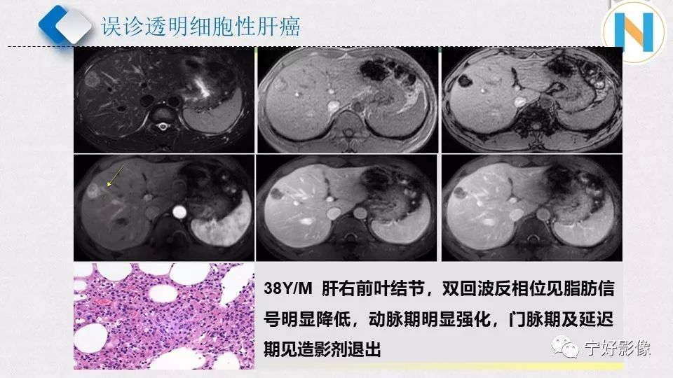 【PPT】肝脏血管平滑肌脂肪瘤影像表现及鉴别诊断 【PPT】肝脏血管平滑肌脂肪瘤影像表现及鉴别诊断