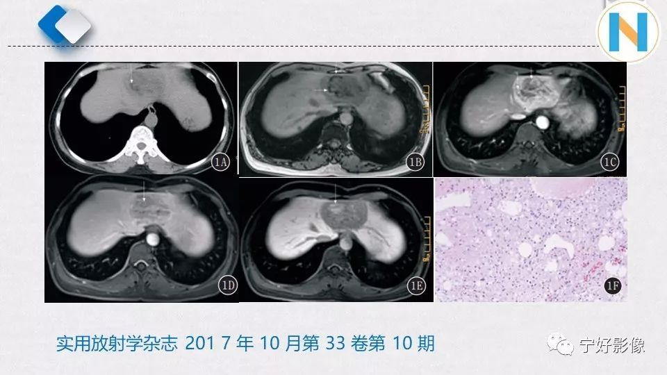 【PPT】肝脏血管平滑肌脂肪瘤影像表现及鉴别诊断 【PPT】肝脏血管平滑肌脂肪瘤影像表现及鉴别诊断