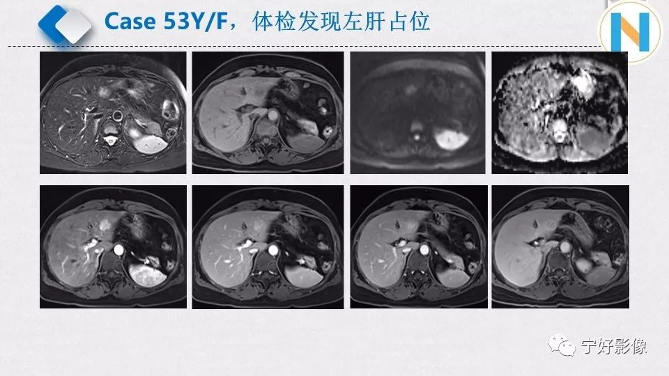 【PPT】肝脏血管平滑肌脂肪瘤影像表现及鉴别诊断 【PPT】肝脏血管平滑肌脂肪瘤影像表现及鉴别诊断