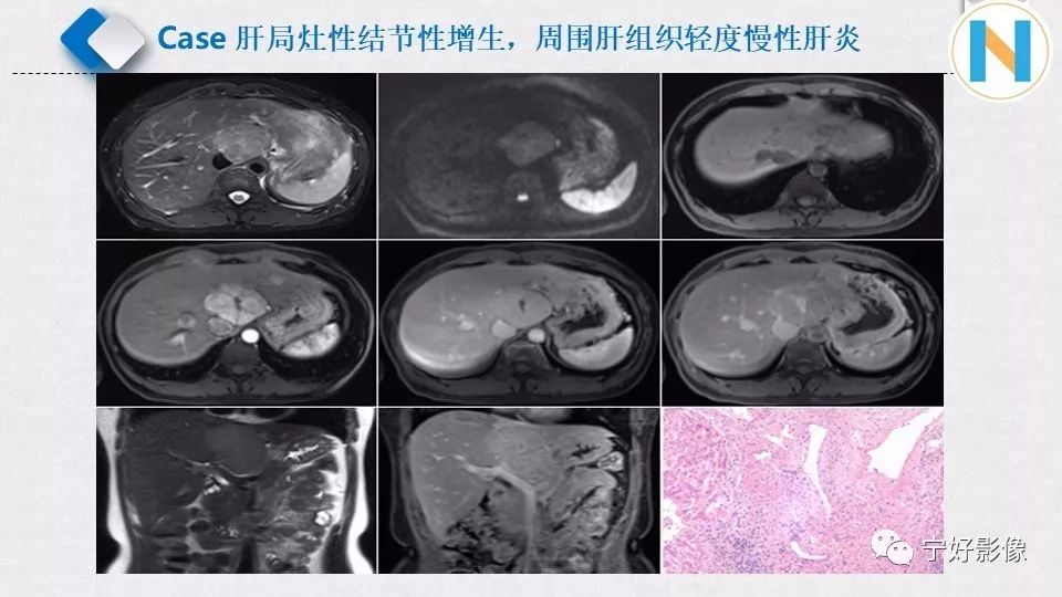 【PPT】肝脏血管平滑肌脂肪瘤影像表现及鉴别诊断 【PPT】肝脏血管平滑肌脂肪瘤影像表现及鉴别诊断