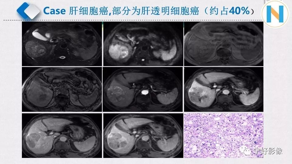 【PPT】肝脏血管平滑肌脂肪瘤影像表现及鉴别诊断 【PPT】肝脏血管平滑肌脂肪瘤影像表现及鉴别诊断