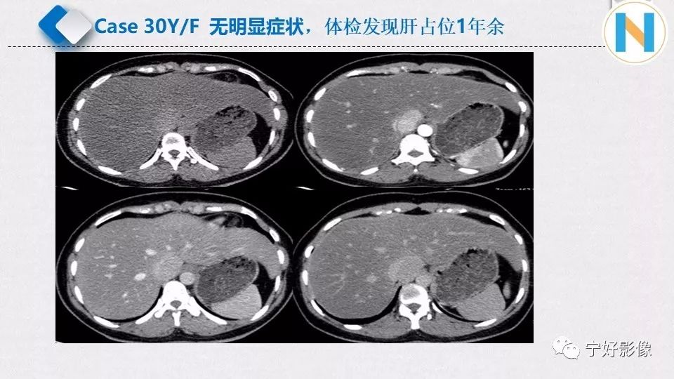 【PPT】肝脏血管平滑肌脂肪瘤影像表现及鉴别诊断 【PPT】肝脏血管平滑肌脂肪瘤影像表现及鉴别诊断