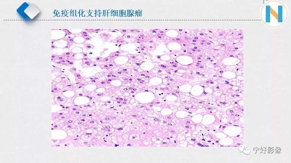 【PPT】肝脏血管平滑肌脂肪瘤影像表现及鉴别诊断 【PPT】肝脏血管平滑肌脂肪瘤影像表现及鉴别诊断
