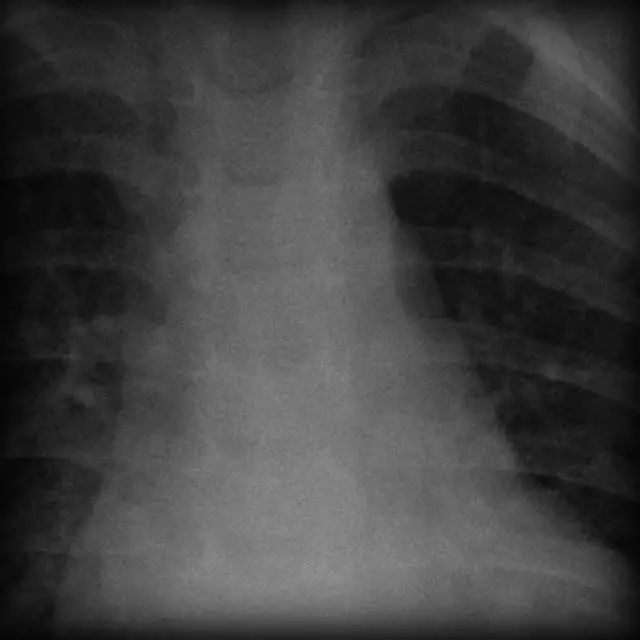 【病例】解密线索:肋骨上的切迹 【病例】解密线索:肋骨上的切迹