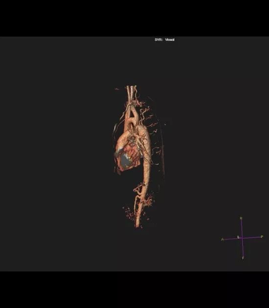 【病例】解密线索:肋骨上的切迹 【病例】解密线索:肋骨上的切迹