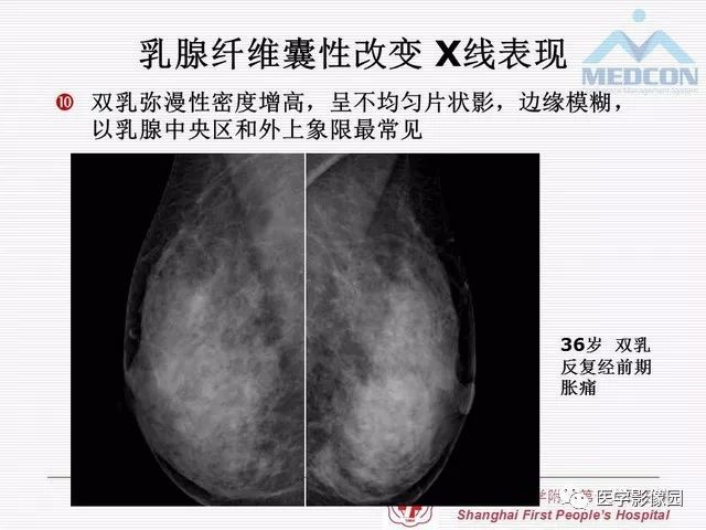 【PPT】乳腺增生X线分类初探