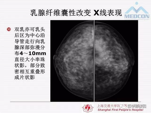 【PPT】乳腺增生X线分类初探