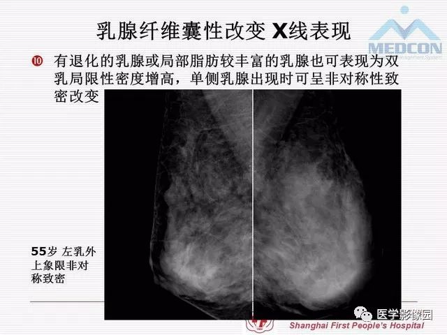 【PPT】乳腺增生X线分类初探