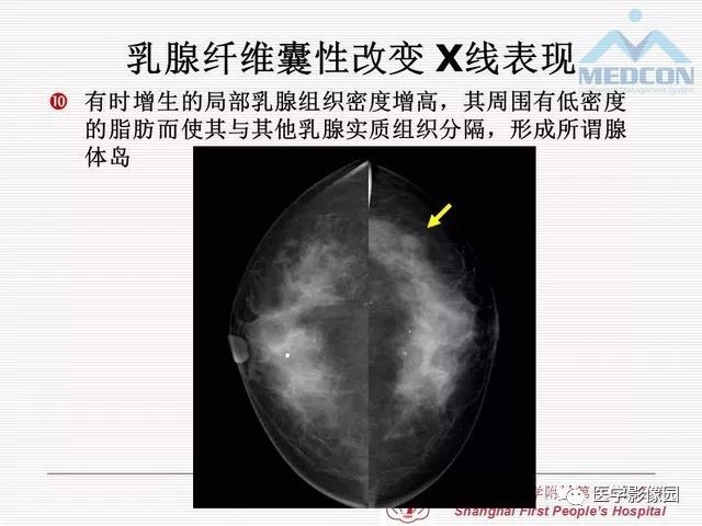【PPT】乳腺增生X线分类初探