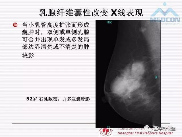 【PPT】乳腺增生X线分类初探