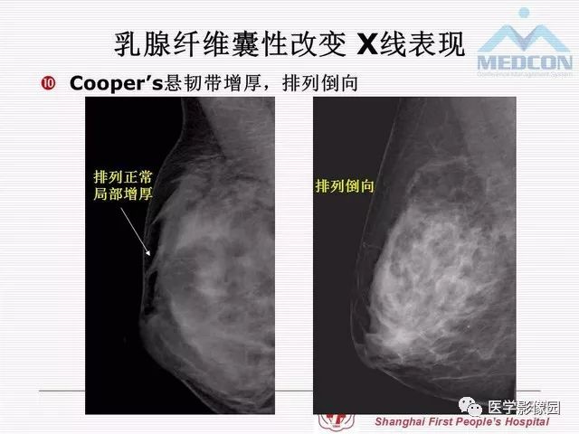 【PPT】乳腺增生X线分类初探