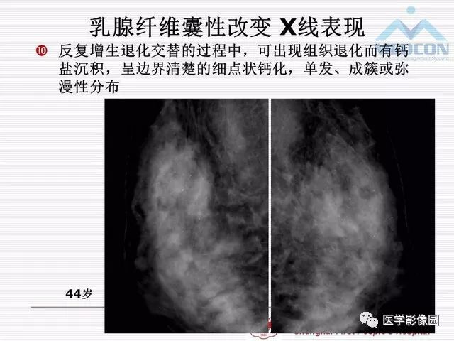 【PPT】乳腺增生X线分类初探