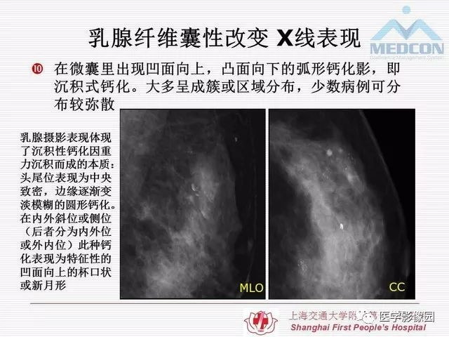【PPT】乳腺增生X线分类初探