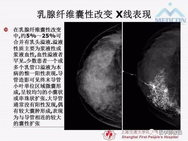 【PPT】乳腺增生X线分类初探