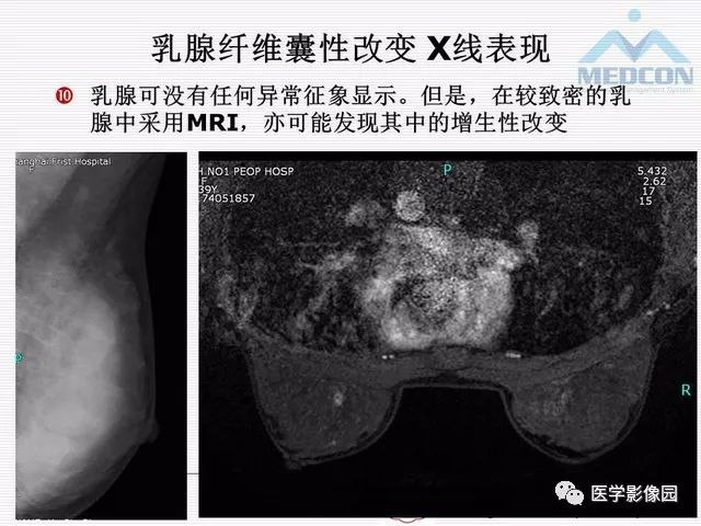 【PPT】乳腺增生X线分类初探