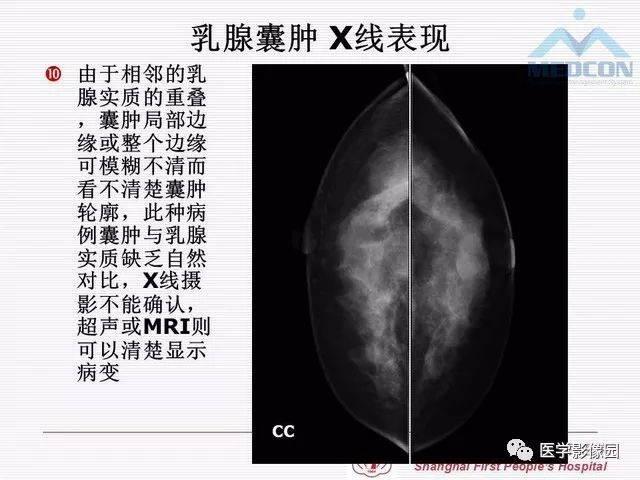 【PPT】乳腺增生X线分类初探
