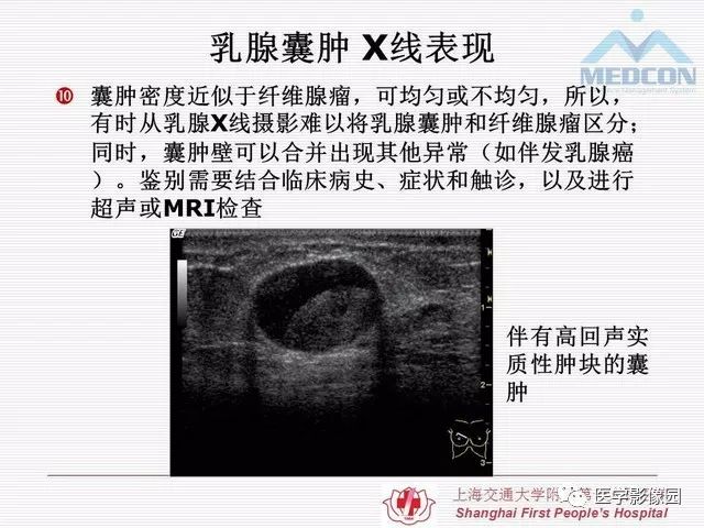 【PPT】乳腺增生X线分类初探