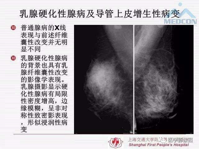 【PPT】乳腺增生X线分类初探