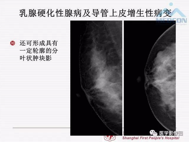 【PPT】乳腺增生X线分类初探