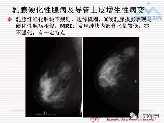 【PPT】乳腺增生X线分类初探