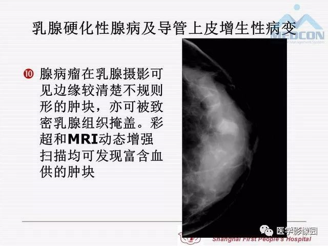 【PPT】乳腺增生X线分类初探