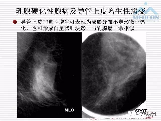 【PPT】乳腺增生X线分类初探