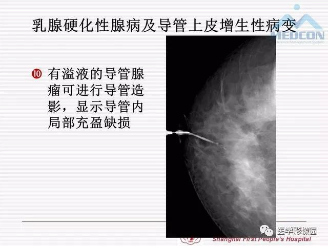 【PPT】乳腺增生X线分类初探