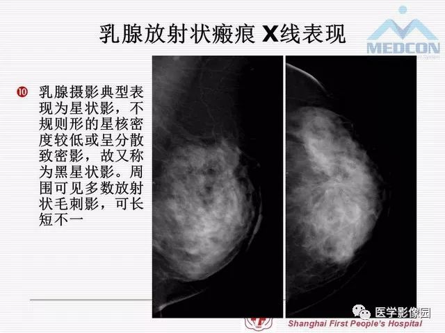 【PPT】乳腺增生X线分类初探