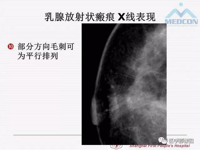 【PPT】乳腺增生X线分类初探