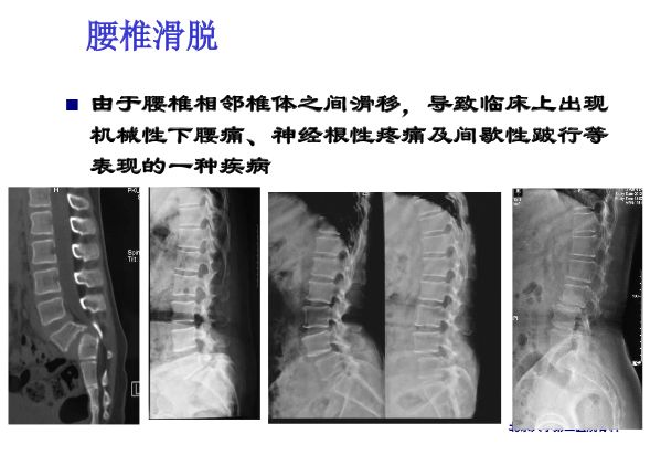 【PPT】腰椎滑脱的临床分型与影像学诊断