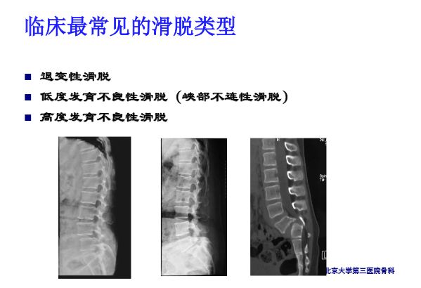 【PPT】腰椎滑脱的临床分型与影像学诊断