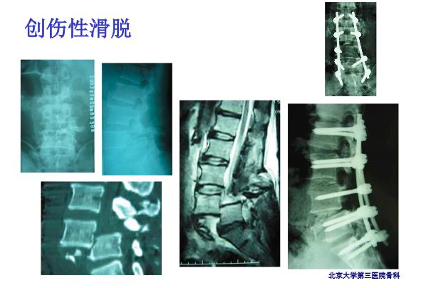 【PPT】腰椎滑脱的临床分型与影像学诊断